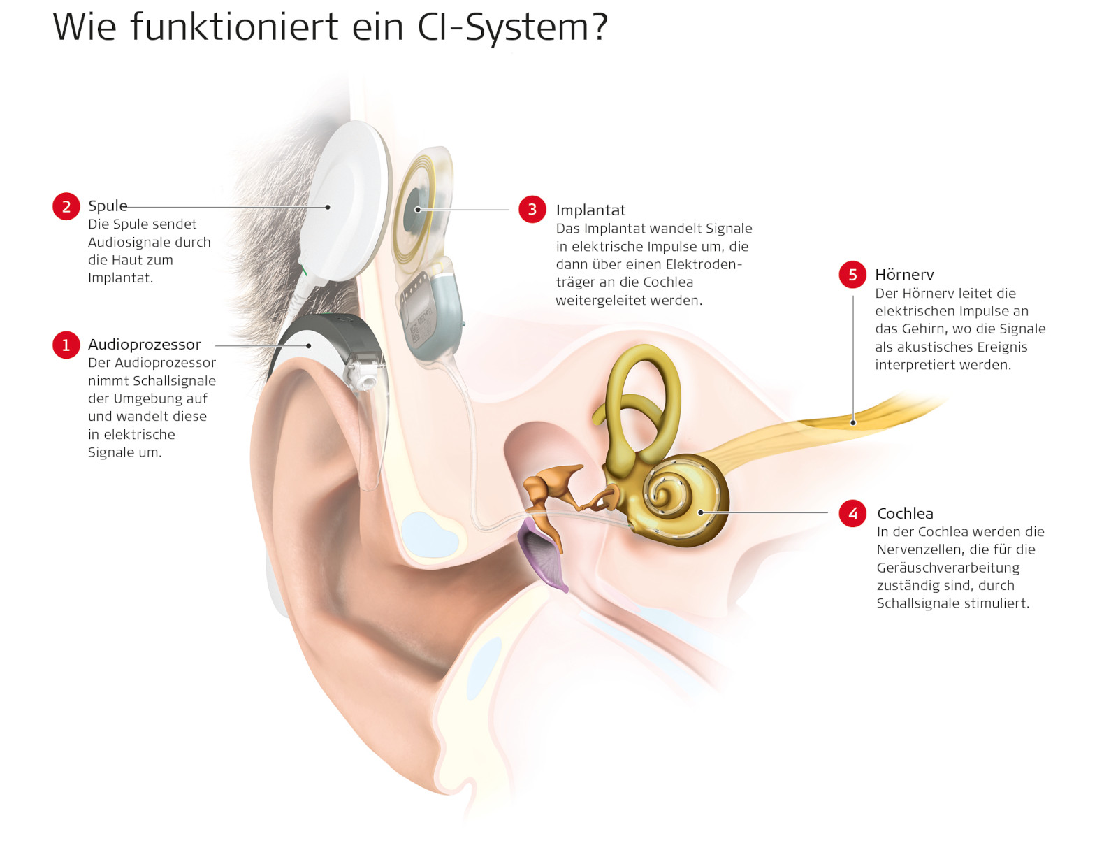 Funktionsweise Cochlea Implantat